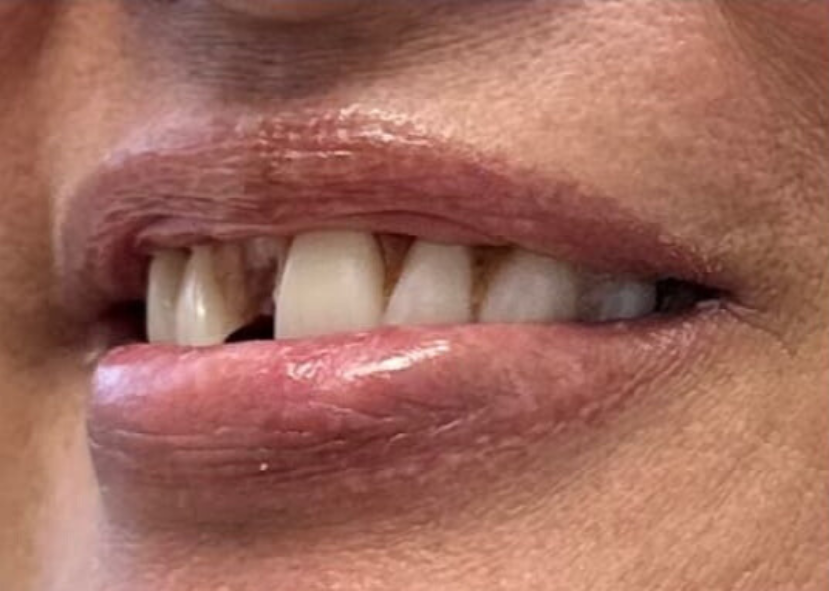Patient before SMILE In A Day dental implant procedure