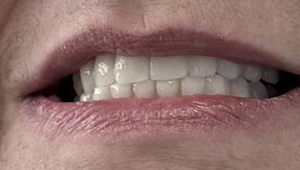 Patient after implants with temporary prosthesis