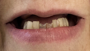 Patient before implants with missing teeth